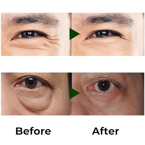Abera Eye Roller Serum – Eye Bags Treatment