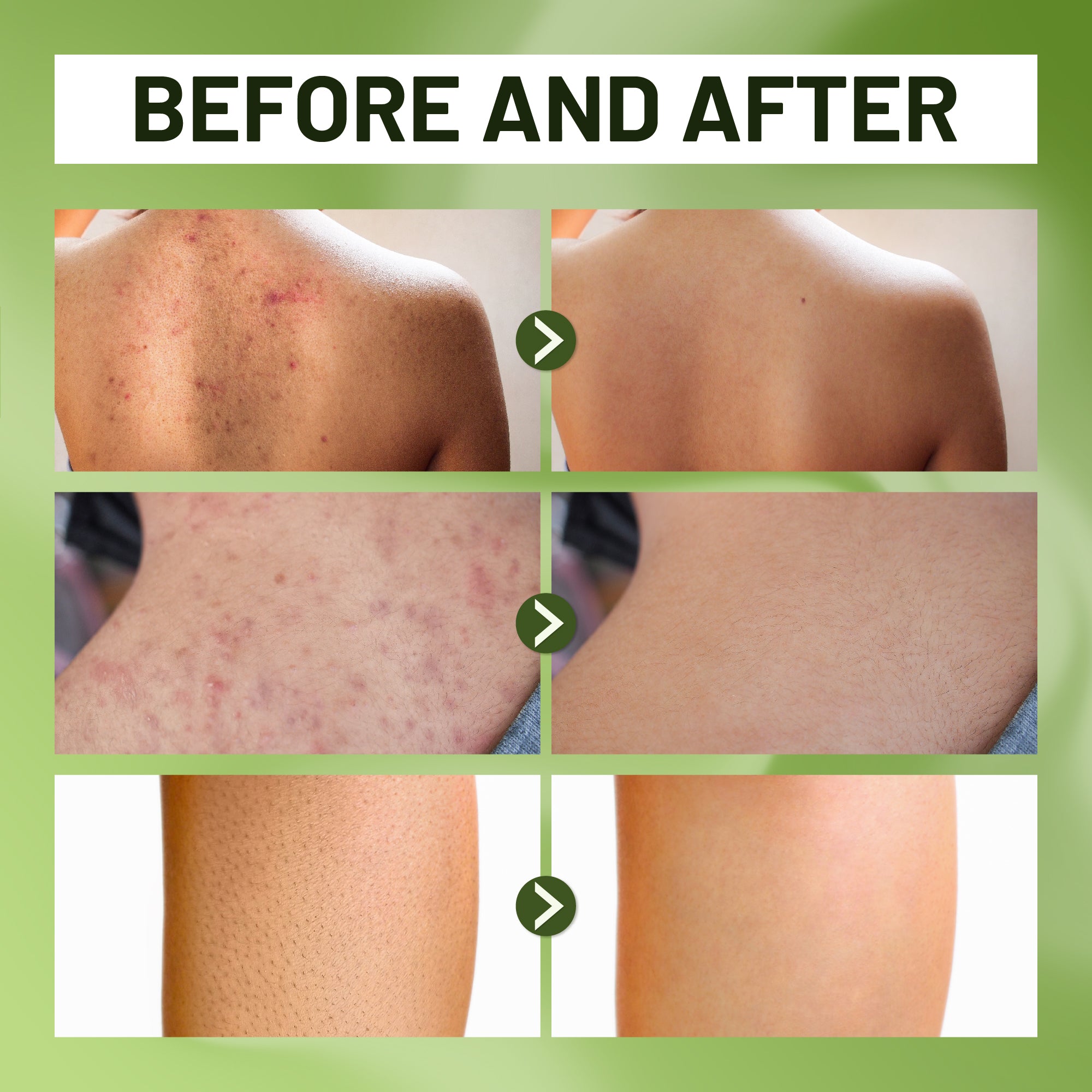 ABERA High-Performance Folliculitis Body Wash