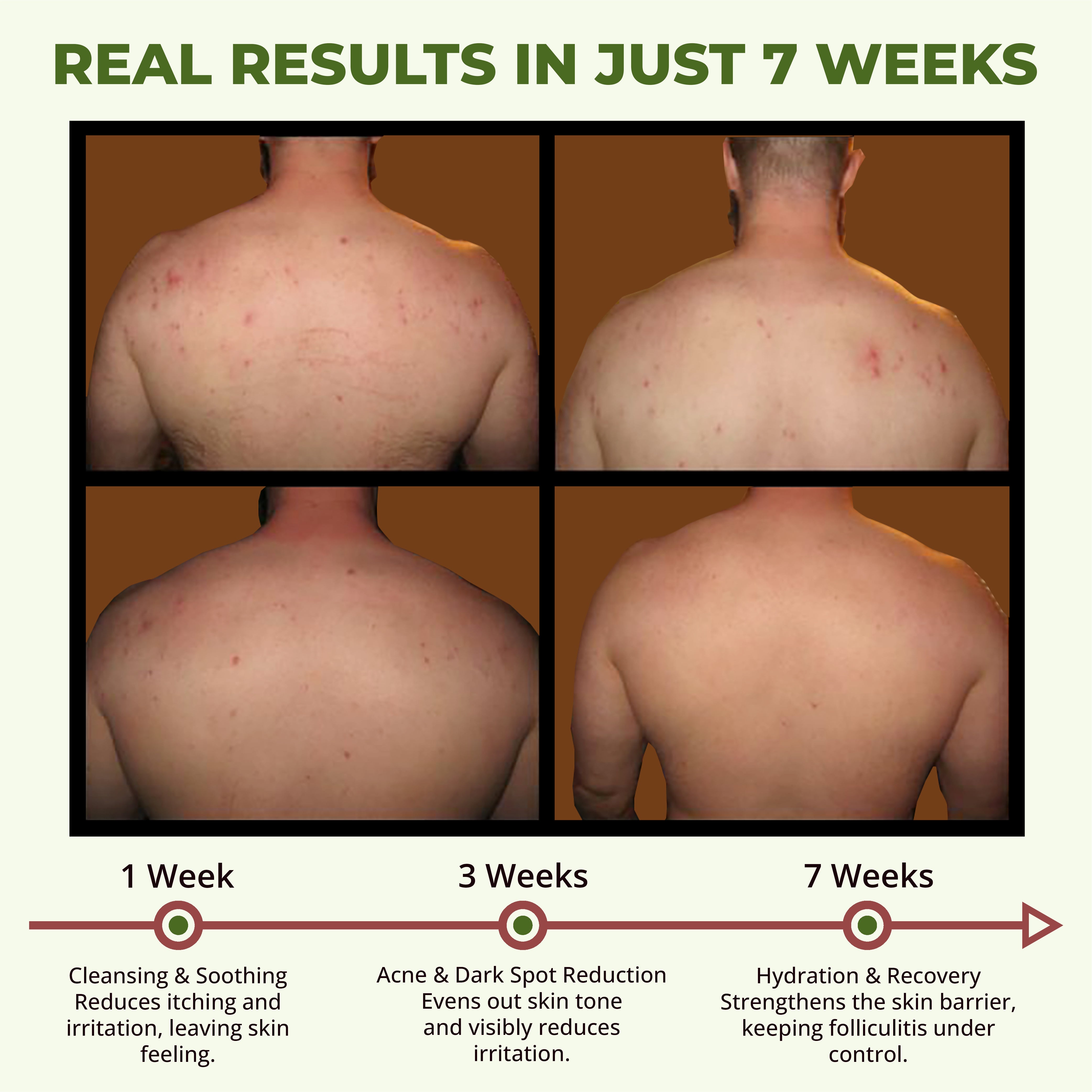 ABERA High-Performance Folliculitis Body Wash